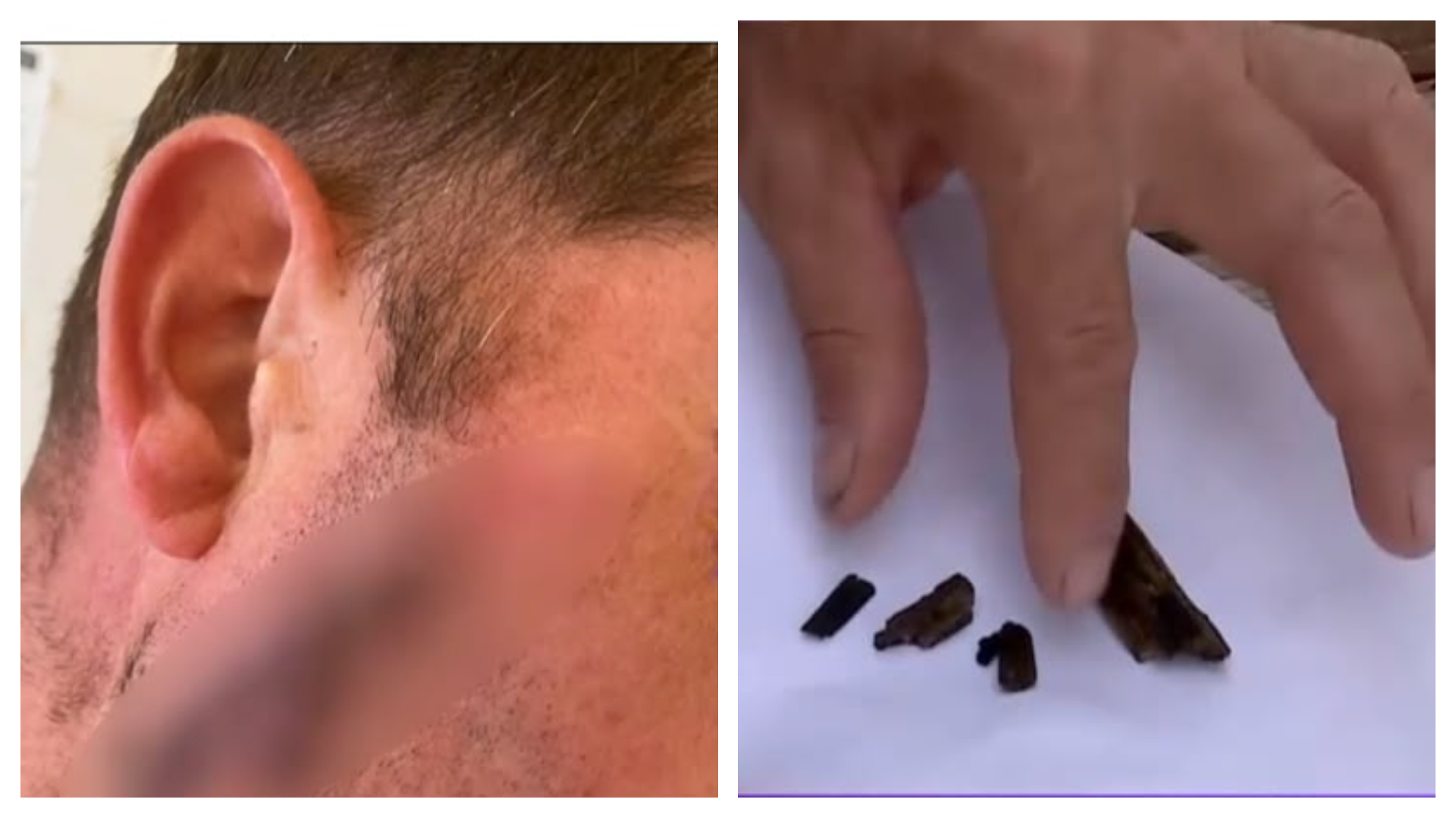Caz revoltător într-un spital! Un bărbat susține că a fost cusut cu o așchie de lemn în obraz și trimis acasă. Ce s-a întâmplat după câteva săptămâni