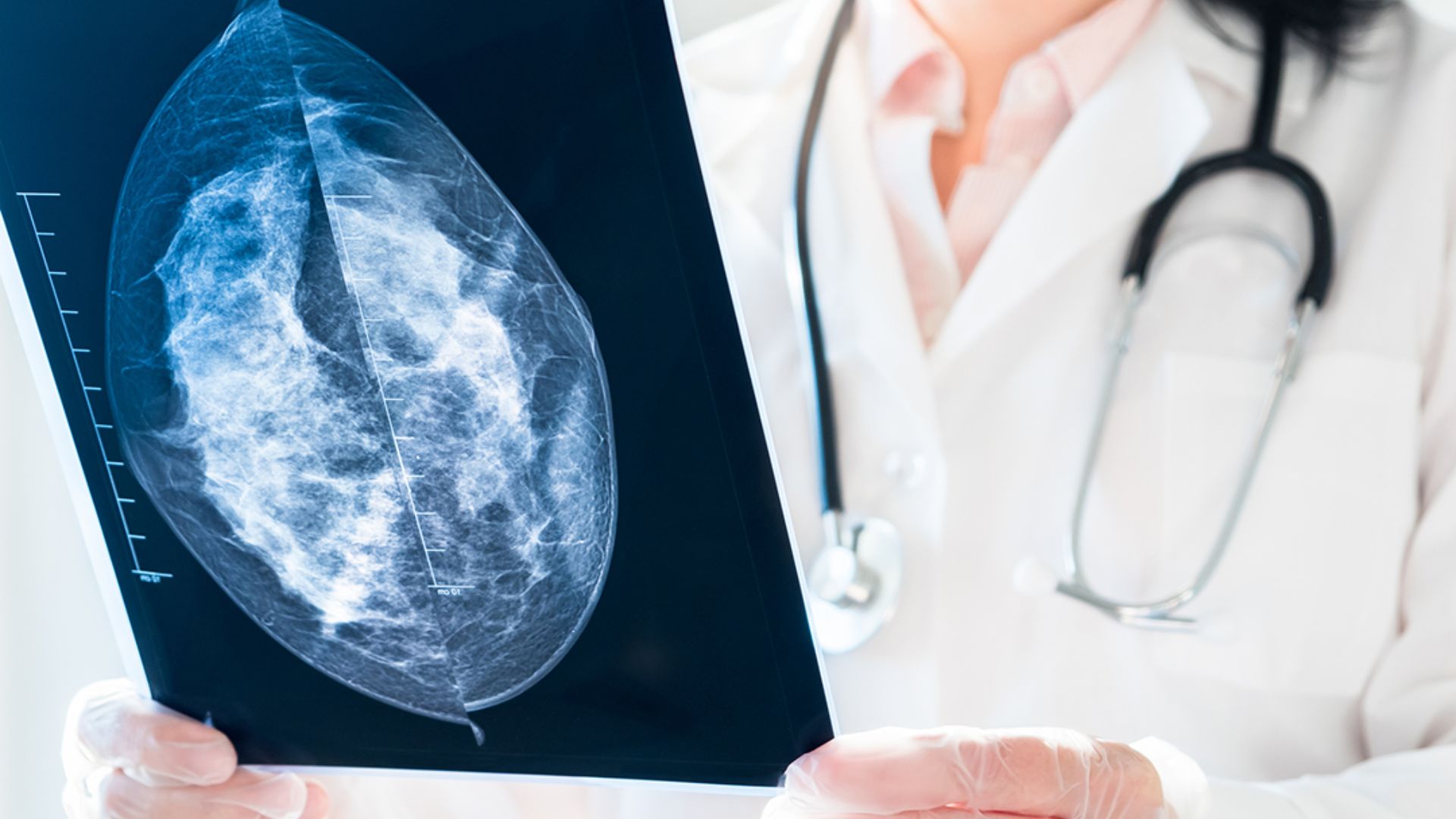 Cercetarea medicală din Cluj trece granițele! Un medic UBBMed, coautor al unui ghid internațional pentru pacientele operate de cancer de sân
